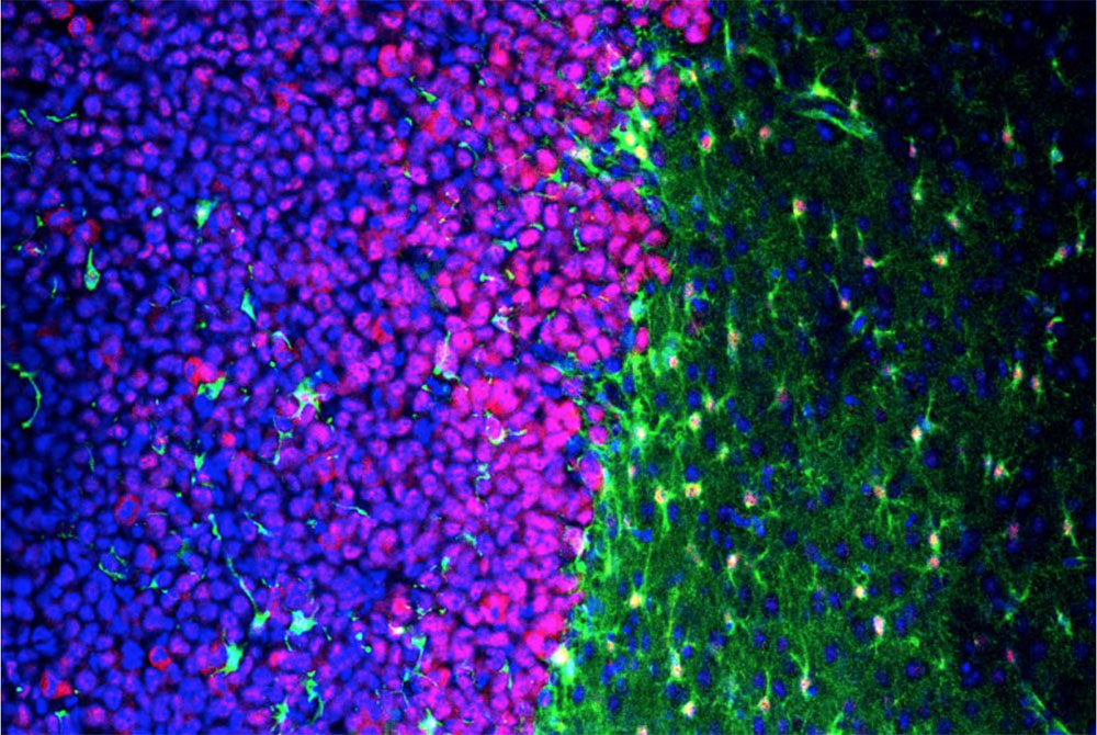 gliomas alter astrocytes