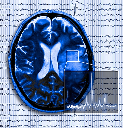 Electrical brain activity