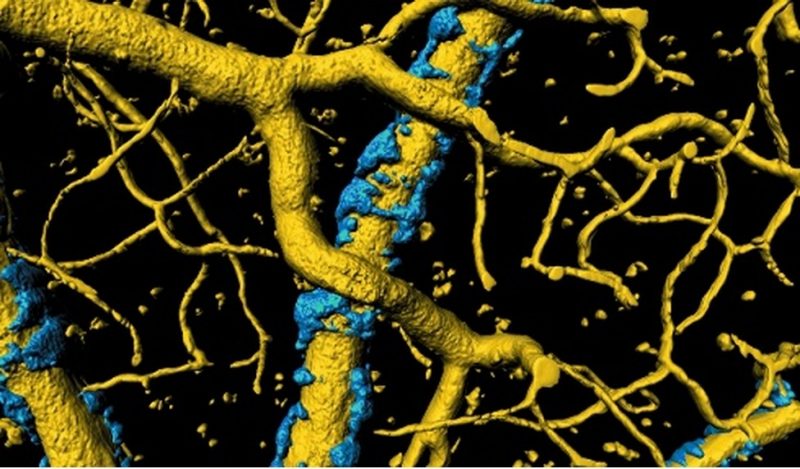 A build up misfolded proteins causes an exoskeleton (in blue) to form around blood vessels (in gold) in the brain